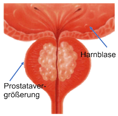 Prostatitis staphylococcus